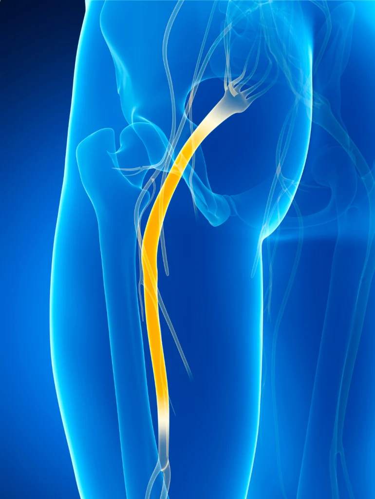 Sciatica Treatment in Oxford